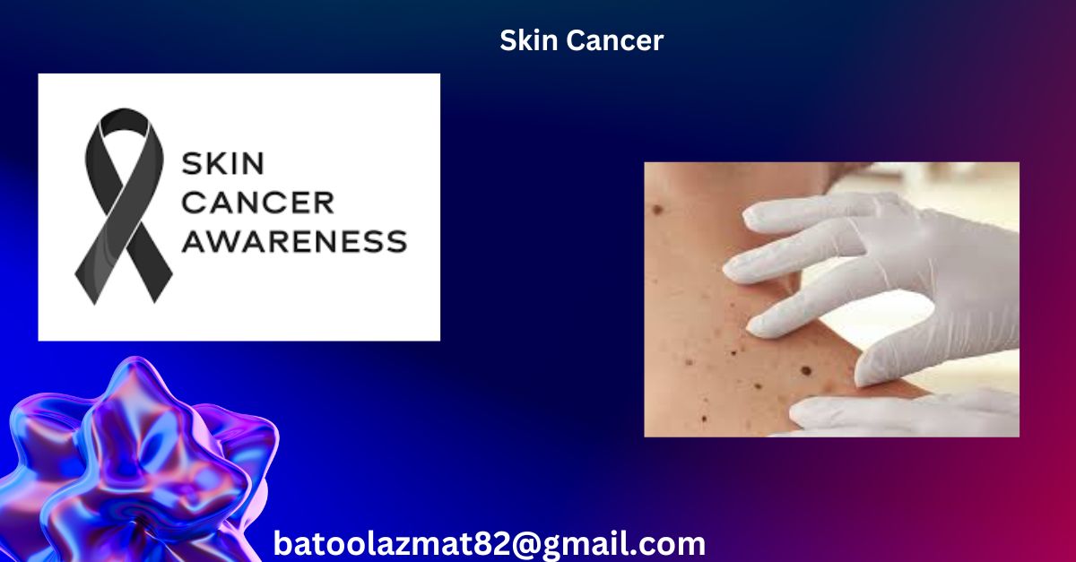 Skin Cancer: